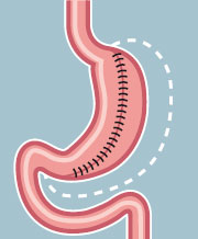 maagverkleining door sleeve gastrectomie
